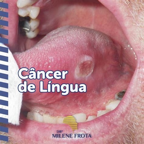 cancer na lingua-1